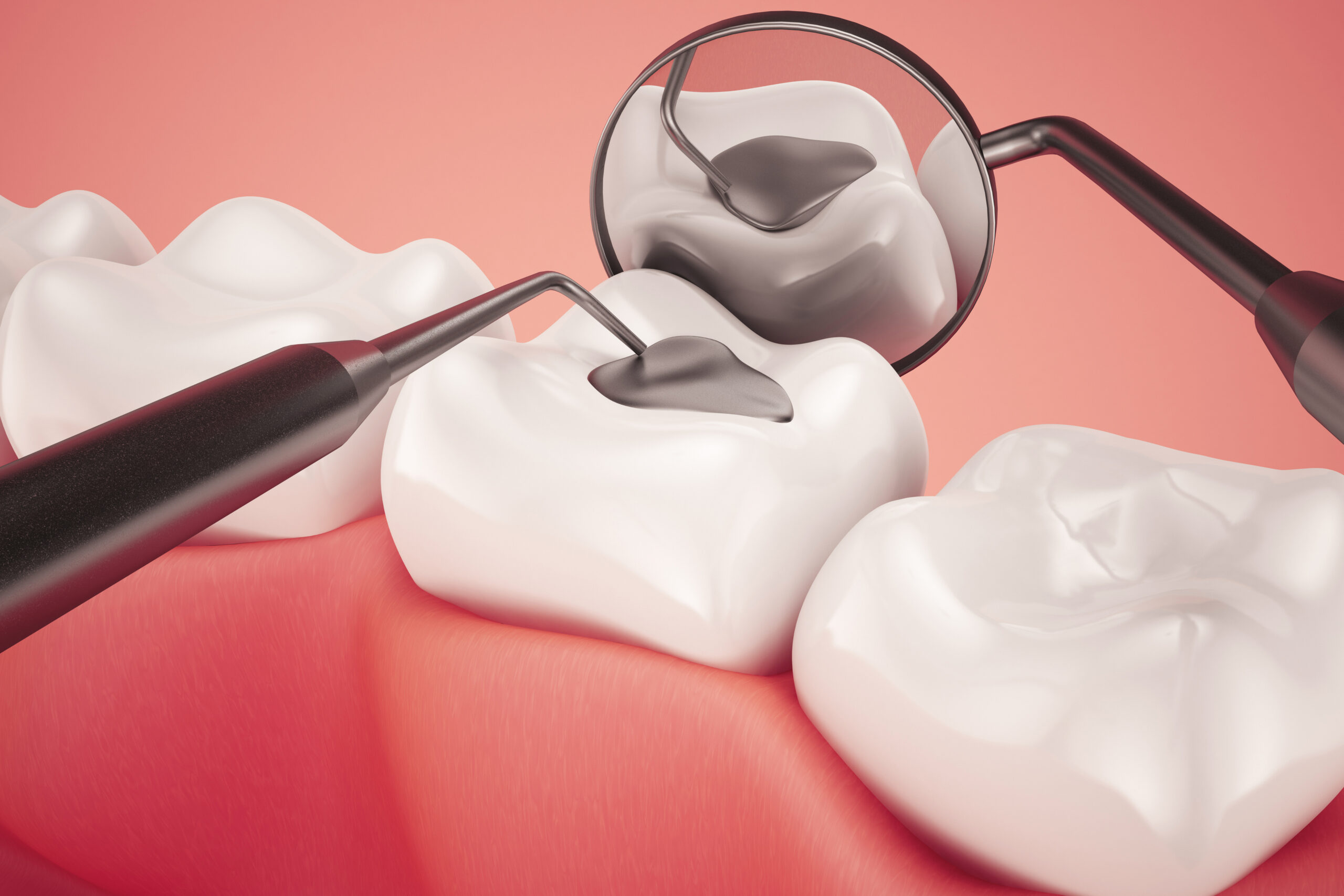 Dental Filling